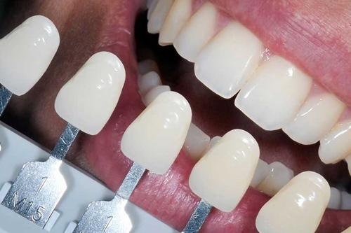 Tooth Colored Fillings